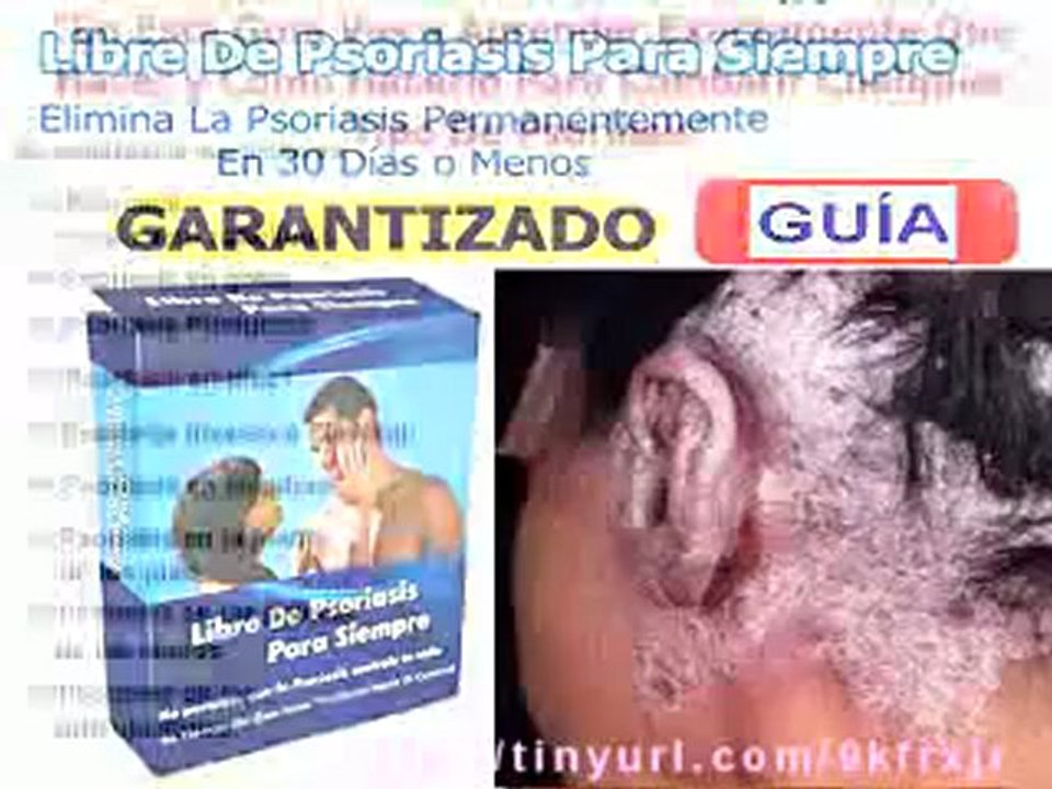 COMO CURAR LA PSORIASIS EN 30 DÍAS O MENOS