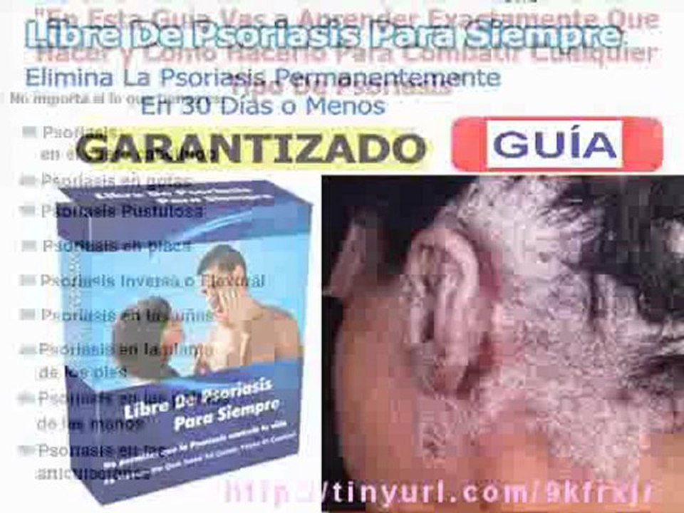 CÓMO CURAR LA PSORIASIS EN 30 DÍAS O MENOS