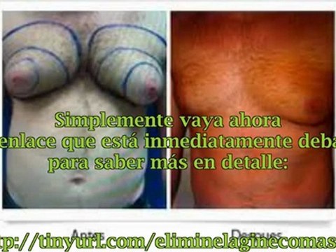 Como curar la ginecomastia sin cirugia