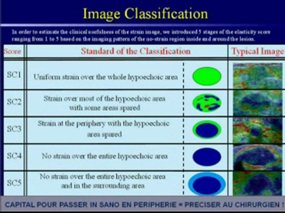 L’ECHOGRAPHIE DUCTALE EST LA SEULE REPONSE A LA DENSITE DU SEIN DES FEMMES