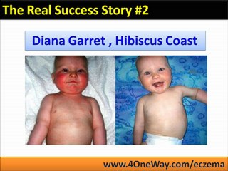 How To Get Rid Of Eczema