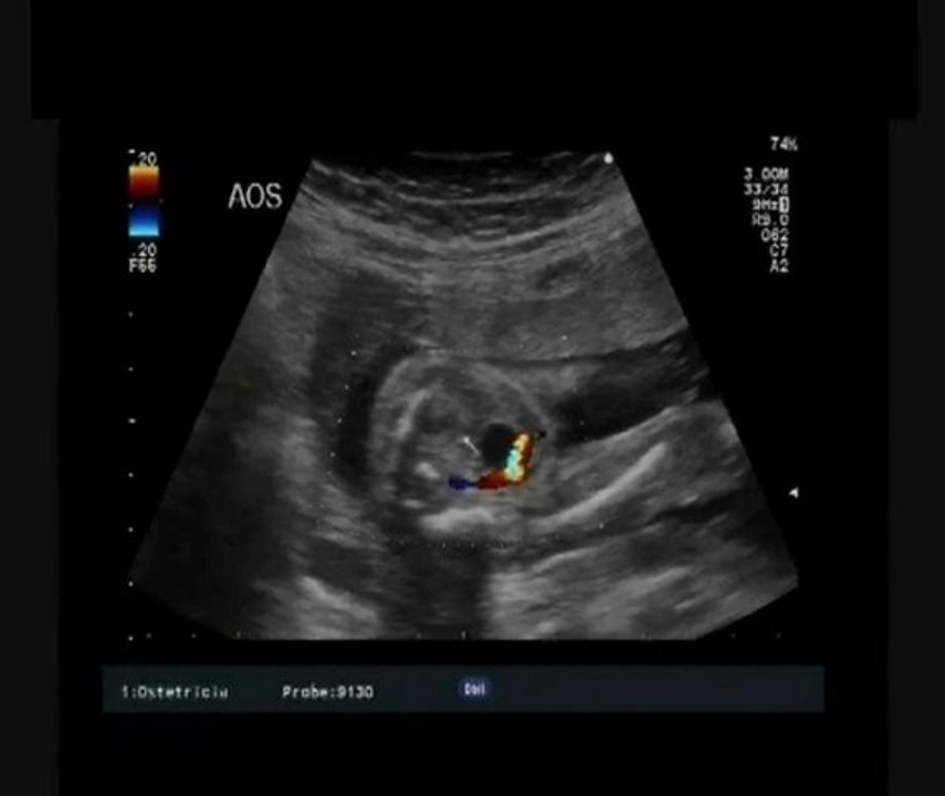 Aloka-Seckel syndrome