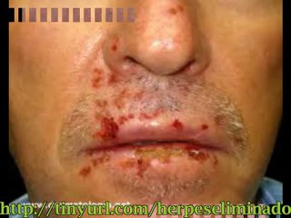 Tratamiento natural para el herpes labial