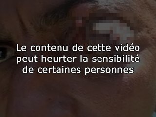 Tumeur de l'oeil