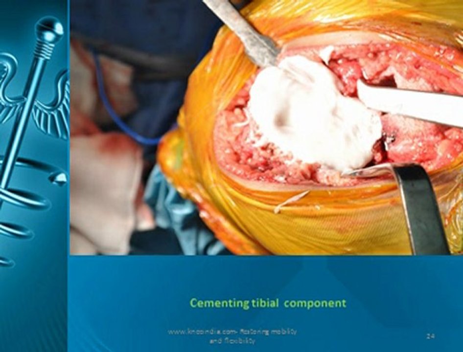 Custom made knee replacement / PSI knee Chennai, India
