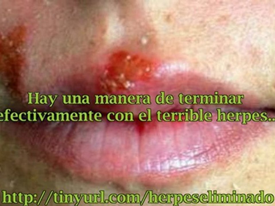 Tratamientos Naturales para el Herpes