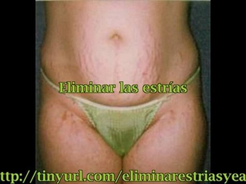 Como Puedo Eliminar las Estrias
