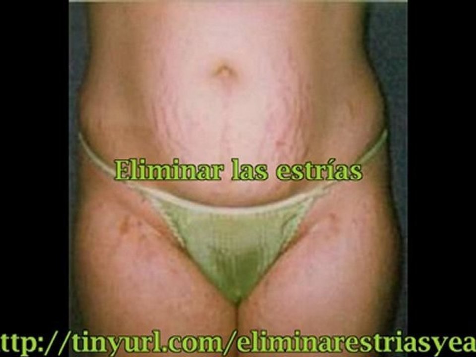 Como Puedo Eliminar las Estrias