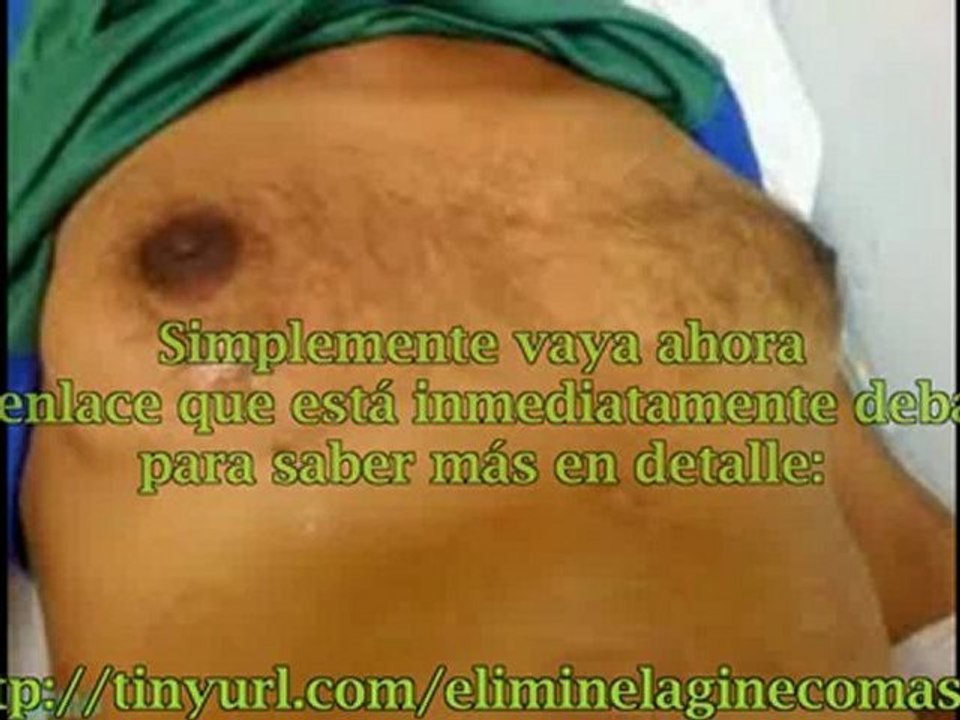 Eliminar Ginecomastia sin Cirugia