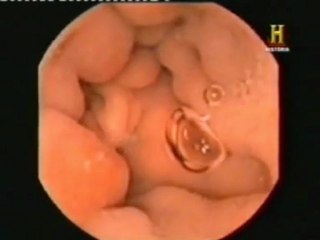 Capsula endoscopica: Historia de un invento