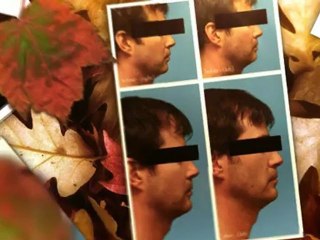 rhinoplasty portland oregon