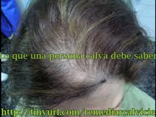 Tratamiento para la caida del cabello en hombres