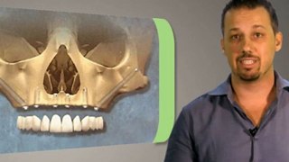 Alternative Dental Implants Procedures - CAID Australia