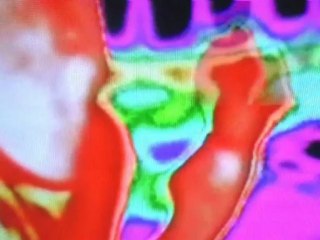 San Damon Ictus 2008-2011.