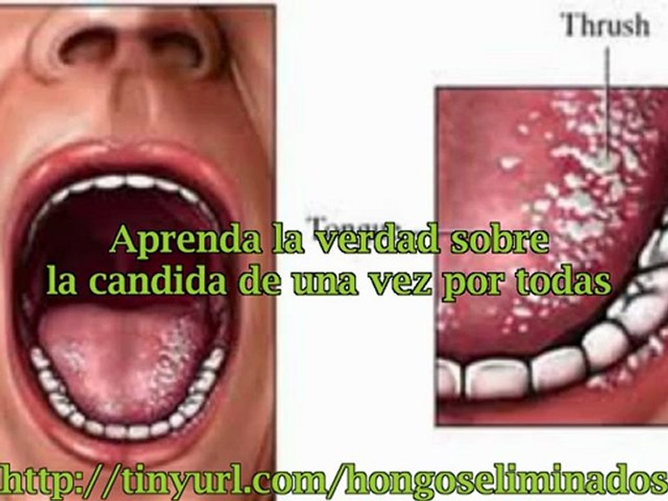 TRATAMIENTOS PARA TODOS LOS TIPOS DE HONGOS