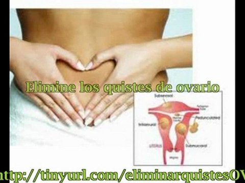 QUISTES EN OVARIOS TRATAMIENTO NATURAL