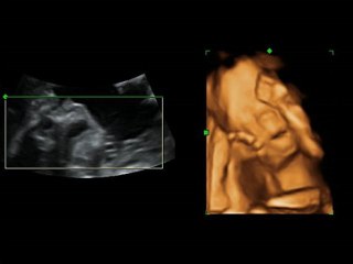 3, 4 boyutlu ultrason bebek görüntüleri (bebek Hamzaoğlu ağzını açıp kapatıyor)