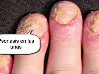 remedios para la psoriasis - remedios naturales para la psoriasis