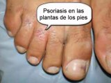 tratamiento natural para psoriasis - remedios caseros para psoriasis