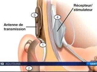 Les implants cochléaires