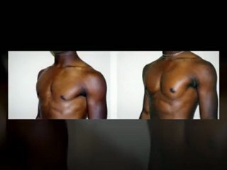 Pectoral Implants Plastic Surgeon NYC