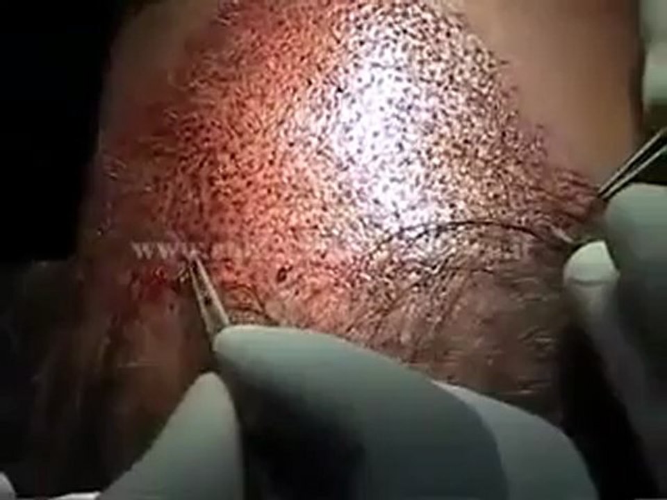 Saç Ektirme Merkezleri İstanbul