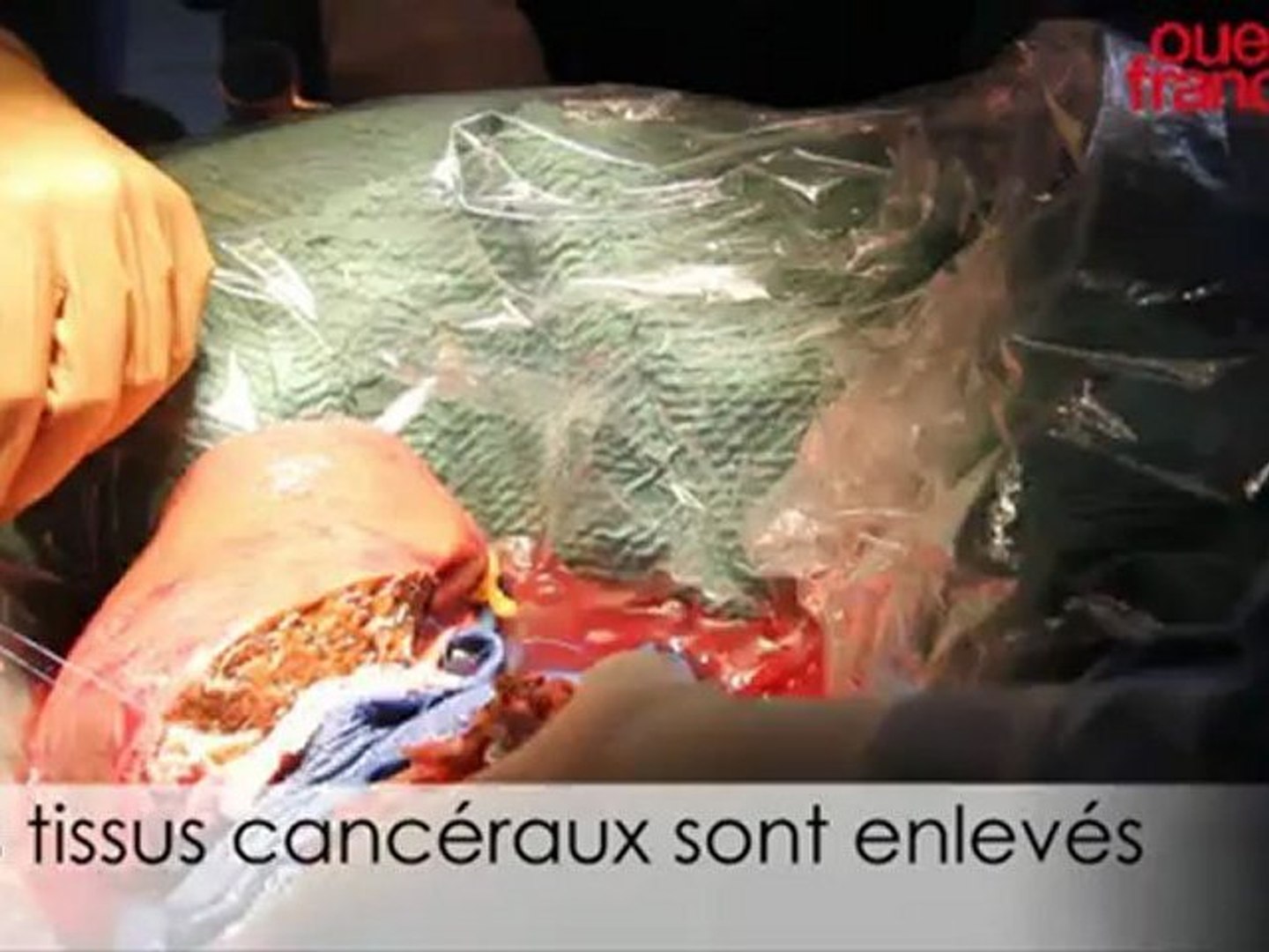 Opération sur un cancer du foie à Rennes