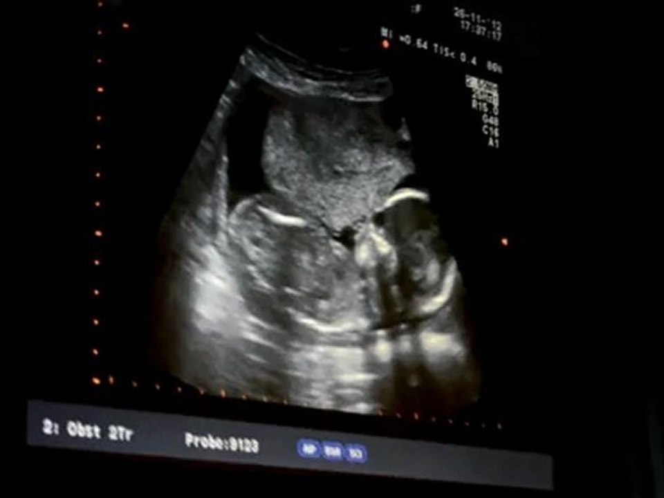 echo novembre 26, 2012 echo 18eme semaines