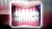 Lake County IL Dentures Full and Partial Dentures Lake County IL