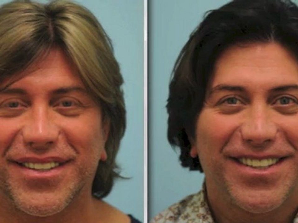 Lip Reduction/Correction from Bad Silicone in Dallas, Texas