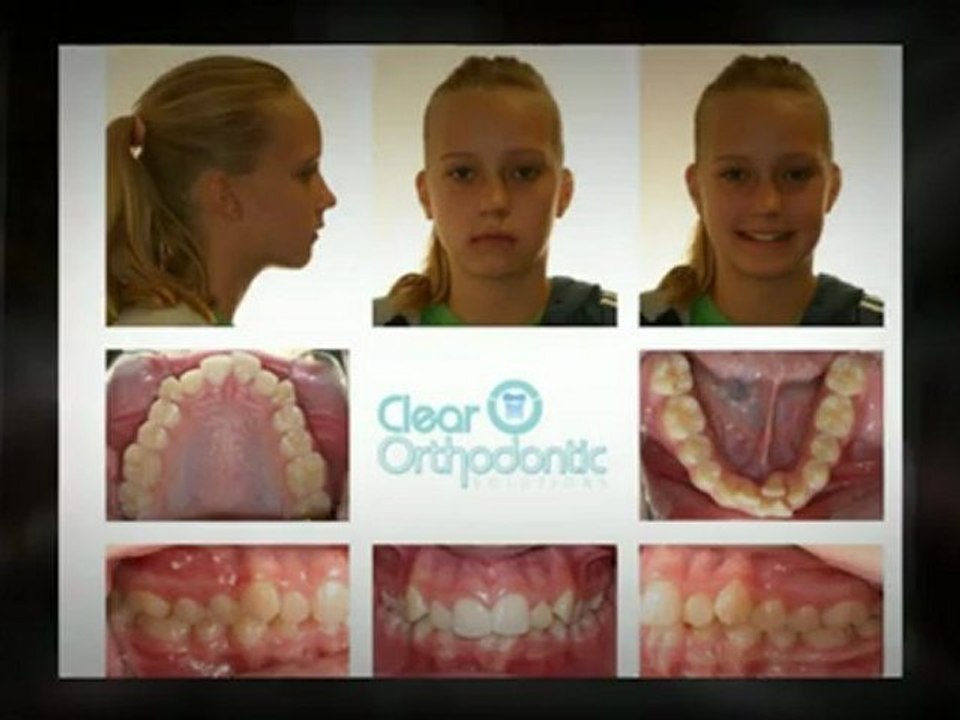 Fort Lauderdale Braces Nov2012