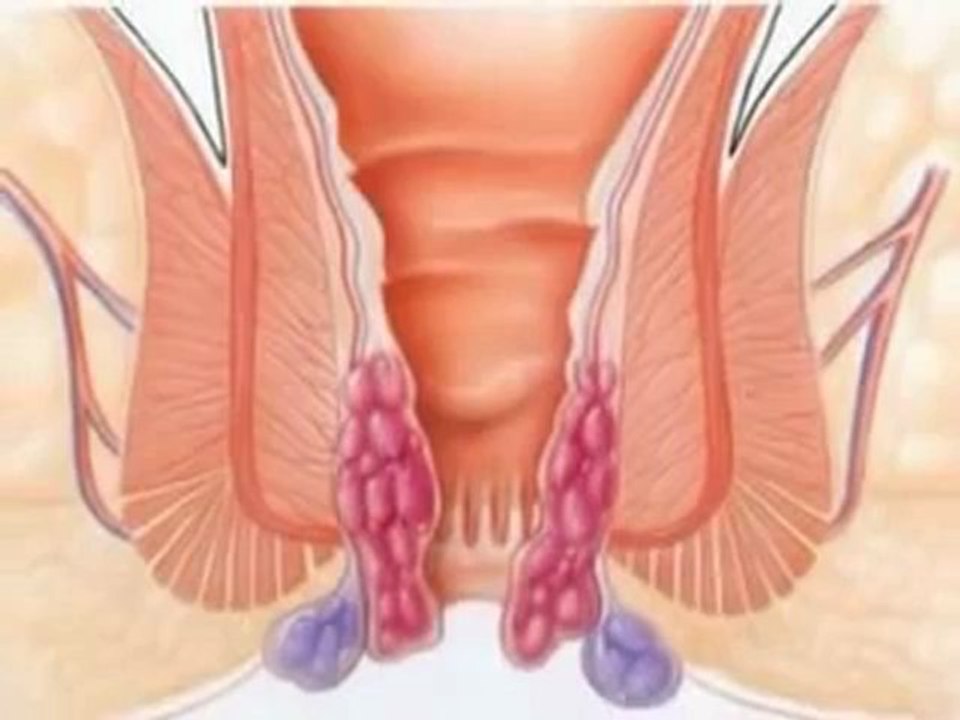 come curare le emorroidi