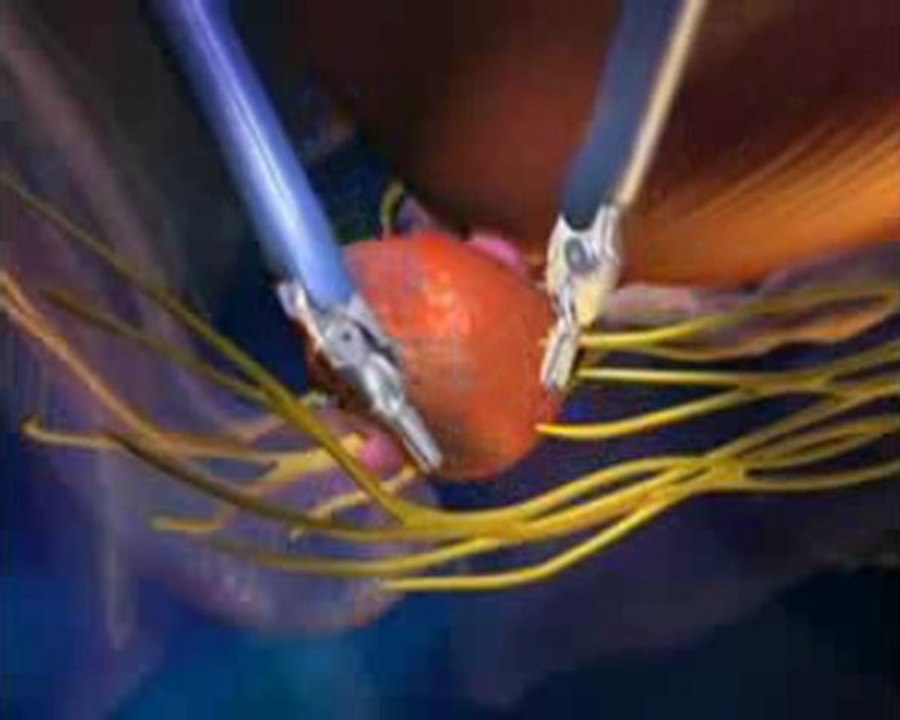 Da vinci Robotik Cerrahi Ameliyatları - Koru Hastanesi +90-312-287-9797