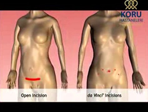 Jinekolojide Robotik Cerrahi - Koru Hastanesi +90-312-287-9797