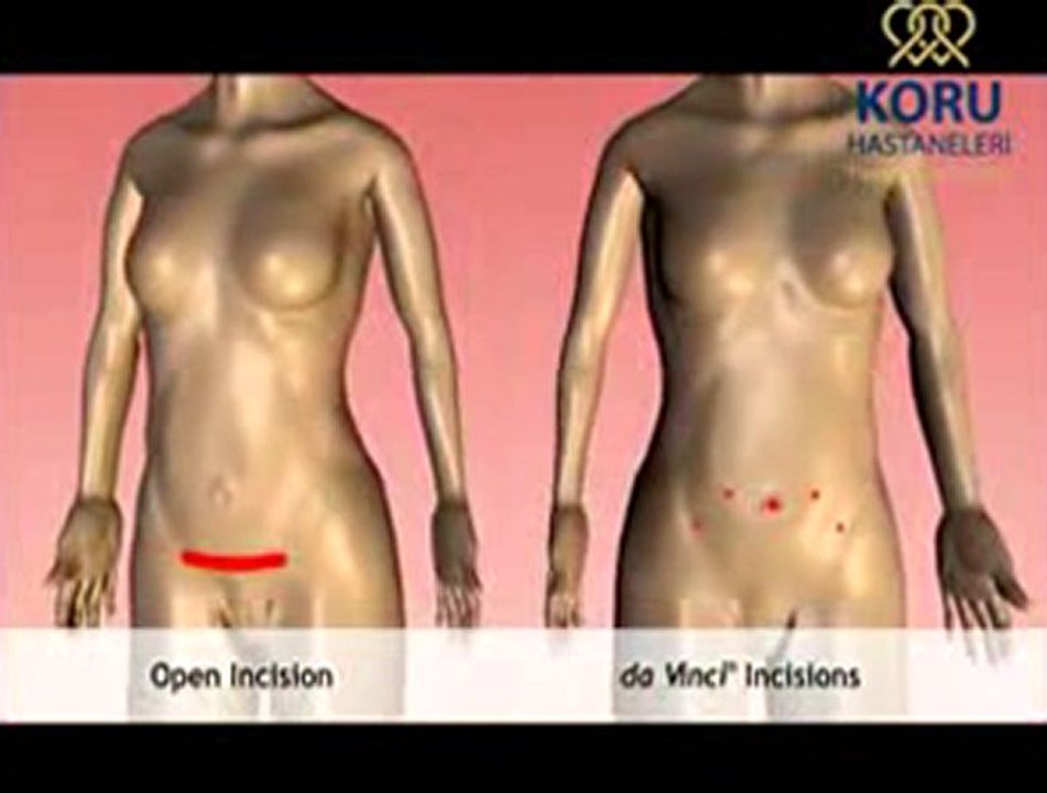 Jinekolojide Robotik Cerrahi - Koru Hastanesi +90-312-287-9797