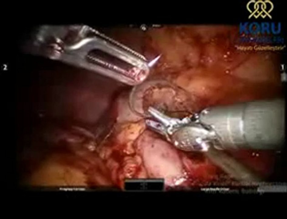 Parsiyel nefrektomi - da Vinci Robotik Cerrahi Sistemi - Koru Hastanesi +90-312-287-9797