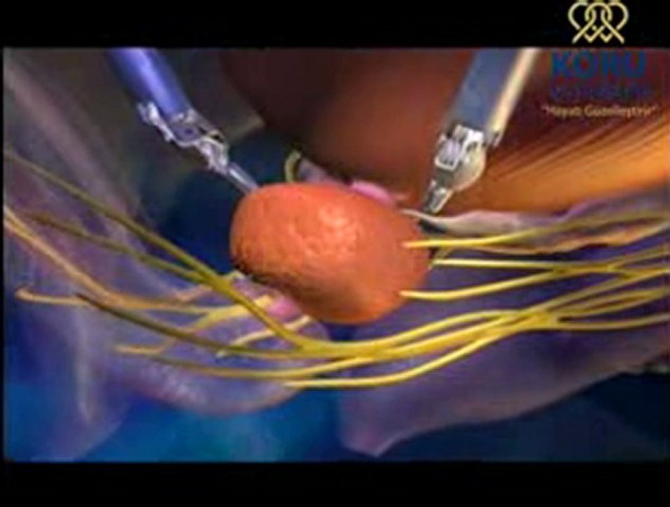 Prostat kanserinde Robotik Cerrahisi - Koru Hastanesi +90-312-287-9797