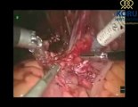 Radikal Cystectomy Robotik Cerrahi - Koru Hastanesi  90-312-287-9797