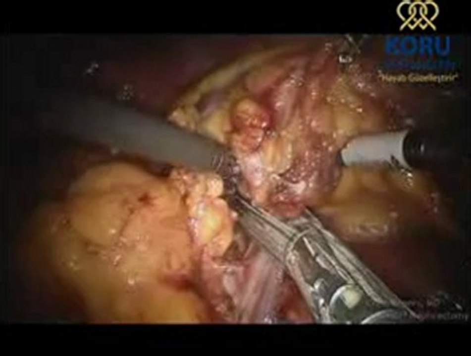 Radikal nefrektomi - da Vinci Robotik Cerrahi Sistemi - Koru Hastanesi +90-312-287-9797