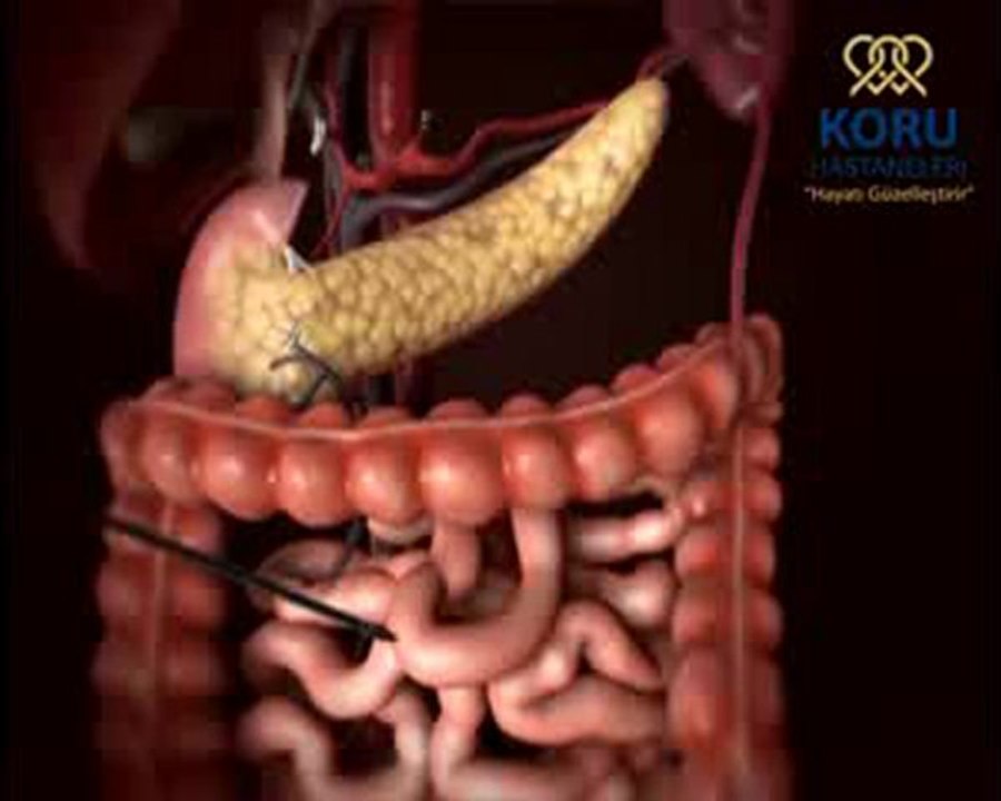 Robotik Cerrahi Ankara - Koru Hastanesi +90-312-287-9797