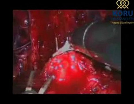 Robotik Cerrahi Merkezi -Prostatektomi - Koru Hastanesi +90-312-287-9797