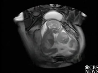 Unborn Twins Fighting For Space In Womb