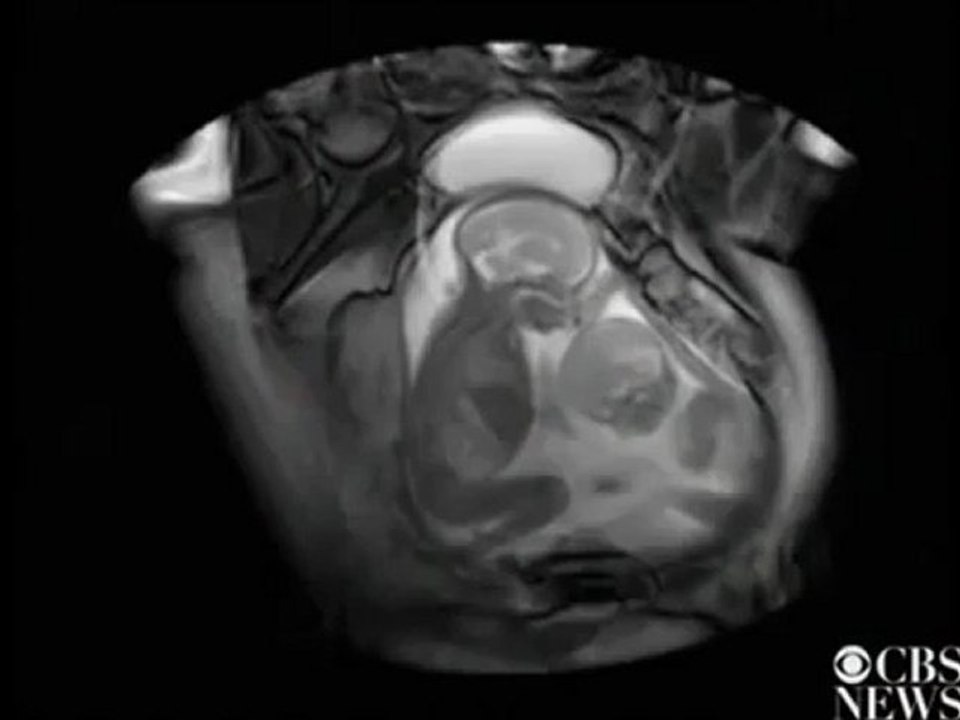 Unborn Twins Fighting For Space In Womb