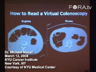 Virtual Colonoscopies and How They Work