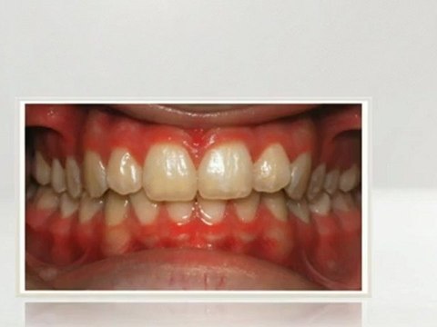 Dallas Invisalign Nov2012