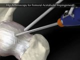 Hip Arthroscopy for Femoral Acetabular Impingement