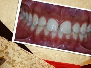 Colorado Springs Braces Nov2012