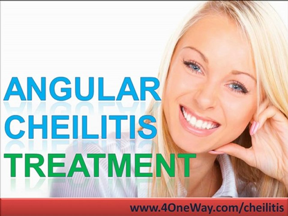 Angular Cheilitis Treatment