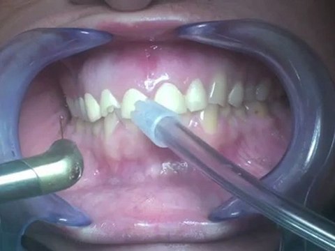 blumia vakasında laser ile dişeti düzenlemsi ardından gülüş tasarımı