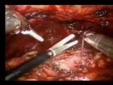 Robotic Assisted Radical Prostatectomy - Centre For Robotic Surgery